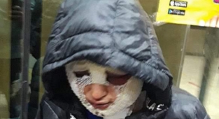 Eski erkek arkadaşı yüzüne kızgın yağ döktü