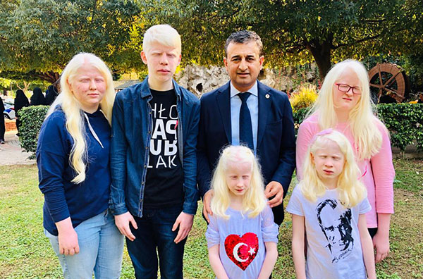 Çukurova'nın Albinoları Güneş Kremi İstiyor